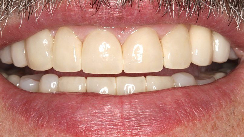 Diastema po leczeniu 2