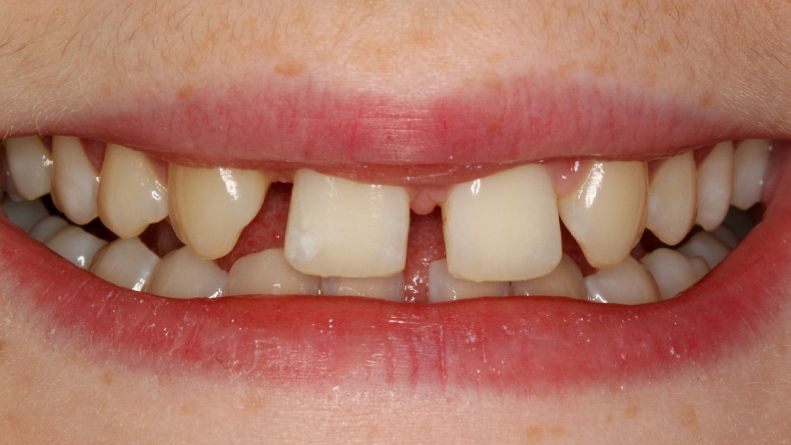 Diastema przed leczeniem 3