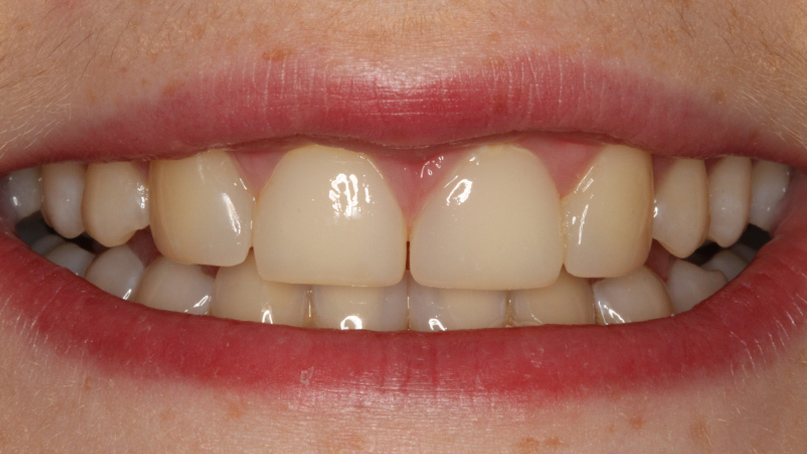 Diastema po leczeniu 3