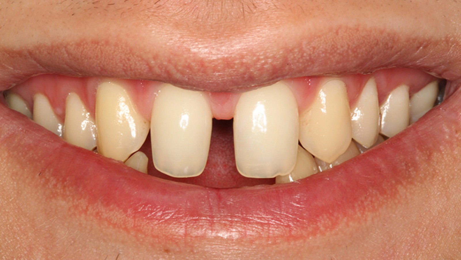 Diastema przed leczeniem 1