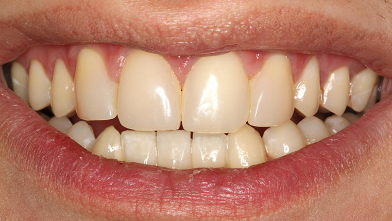 Diastema po leczeniu 1