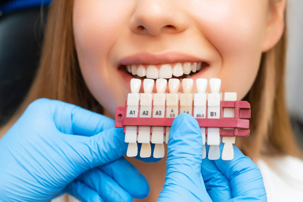 porównanie efektów wybielania zębów